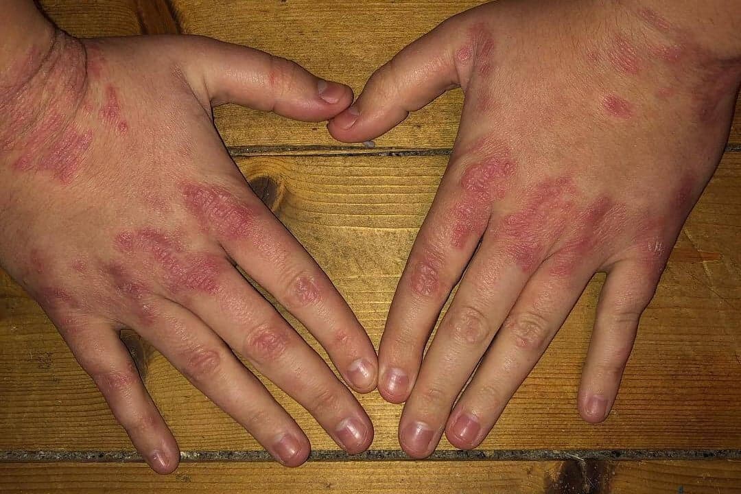 Dermatológiai társulat: A pikkelysömörre ma már van korszerű terápiás lehetőség