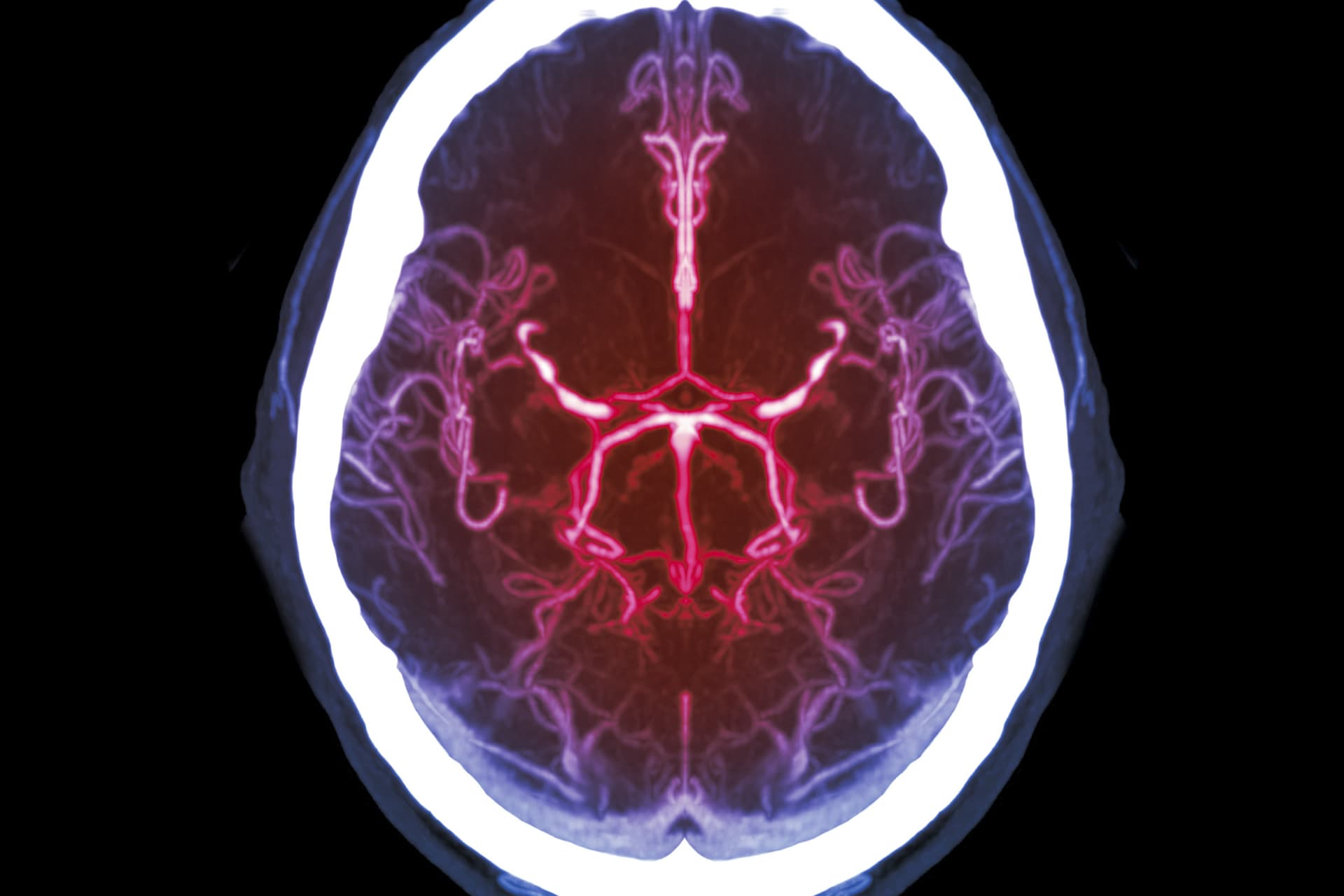 A mesterséges intelligencia felismerheti az agyi artériák szűkületét