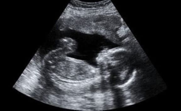 Multinacionális cégek, amelyek finanszírozzák az abortuszturizmust