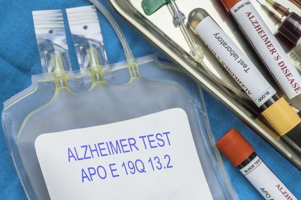 Az Alzheimer-kór a 3-as típusú cukorbetegség?