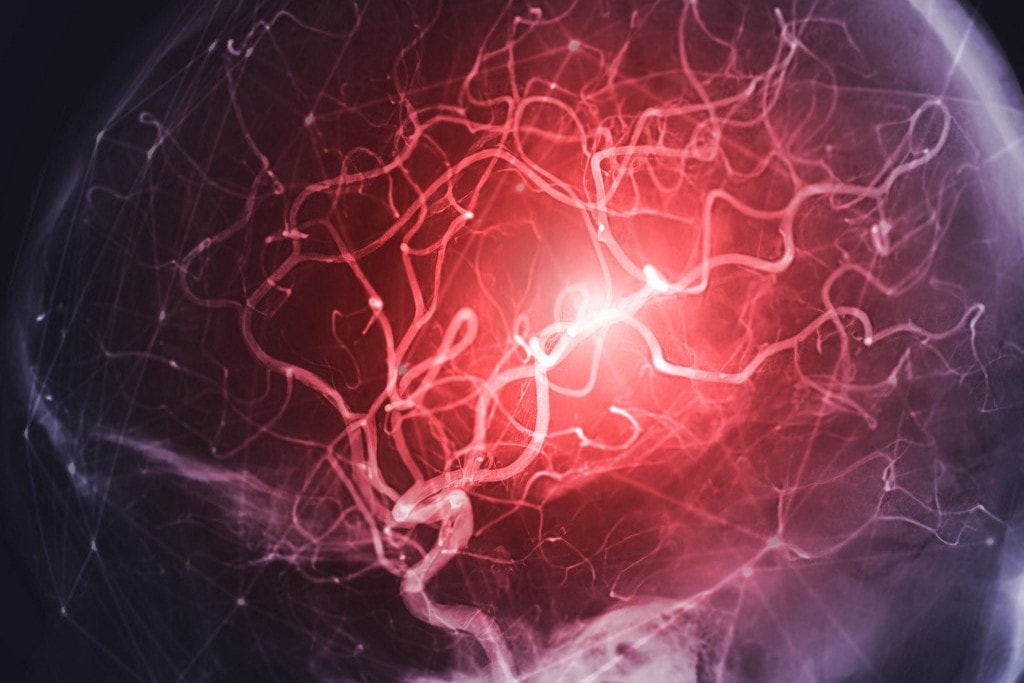 Ezzel az étkezéssel elkerülhetjük a stroke-ot