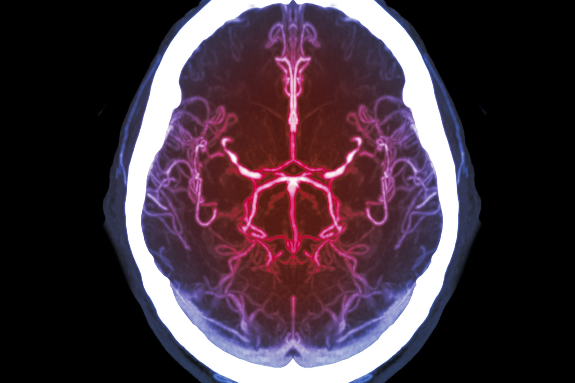 A mesterséges intelligencia felismerheti az agyi artériák szűkületét