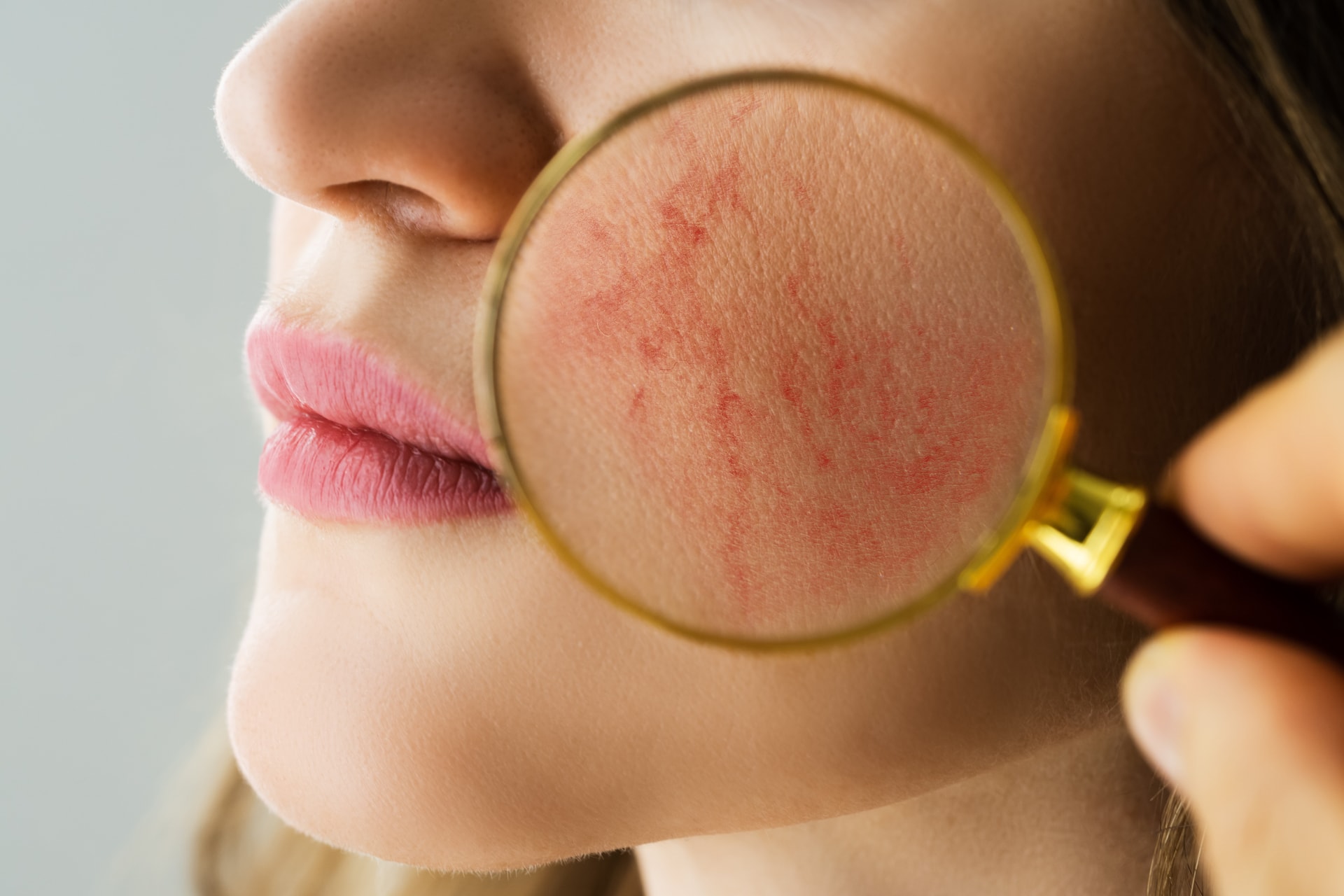 A bőrgyógyász tippeket ad a bosszantó rosacea ellen
