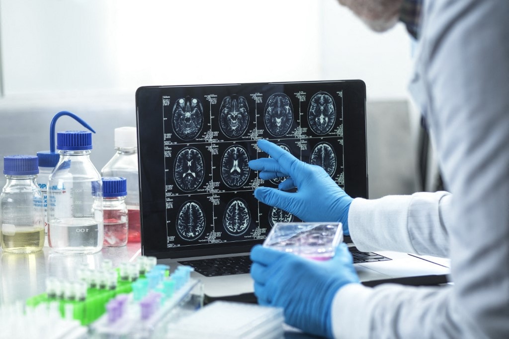 Így előzhető meg a nőknél az Alzheimer-kór