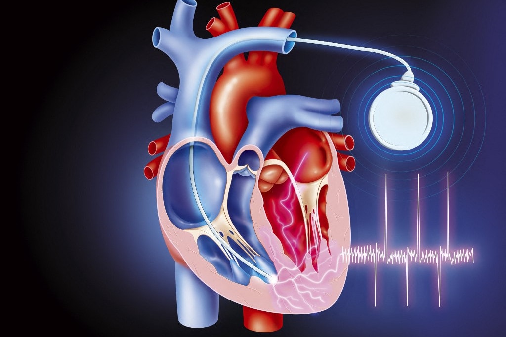 Megkezdte a működését az ország első pacemaker-távambulanciája